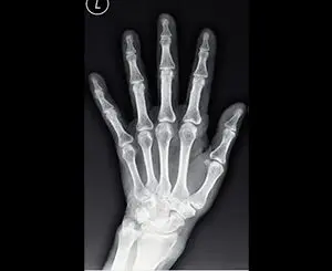 An X-ray of a hand with bones visible with black background
