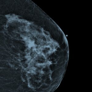 An Overview of Mammography Image
