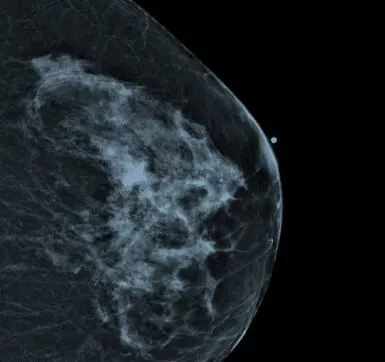 An Overview of Mammography Image