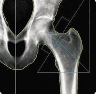 Osteoporosis Diagnostic Imaging