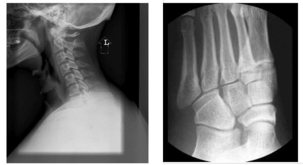 X ray image of neck and fingers of body part